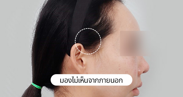 ภาพถ่ายแสดงการยกกระชับร่องแก้มแบบมินิ