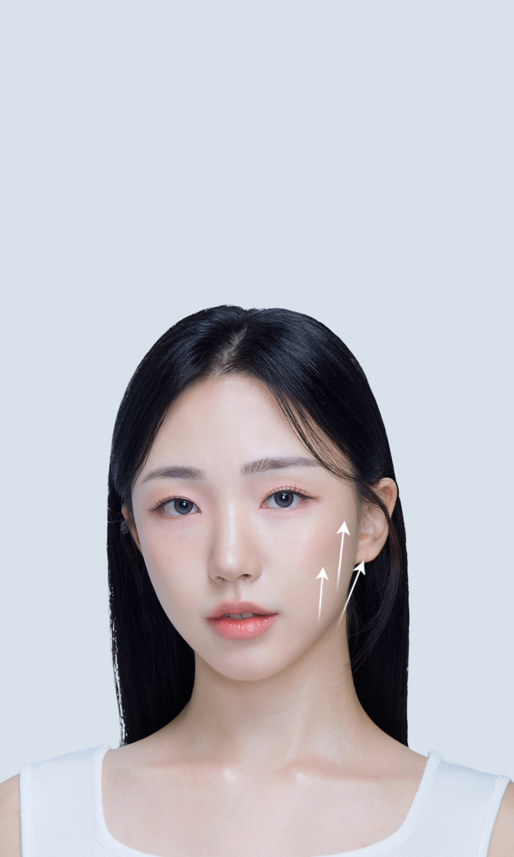 การใช้เส้นไหมยกกระชับ เพื่อดึงชั้น SMAS ผิวชั้นนอกและชั้นหนังแท้ 4X มินิ ลิฟติ้ง