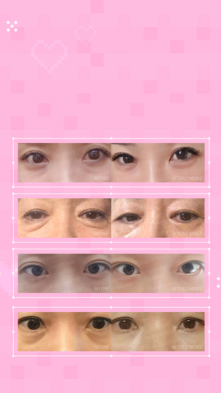 20분의 듀얼Under-eye Fat Repositioning 2주 후의 완벽한 변화