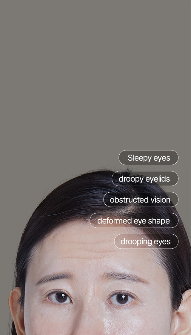 Rejuvenated and younger-looking eyes achieved with a brow lift + Droopy eyelids due to aging + Changes in eye shape + Tired look caused by droopy eyelids  The problems can be addressed all at once with! Brow Lift