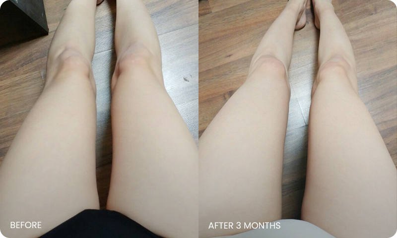 룩팻 지방추출주사 전후사진