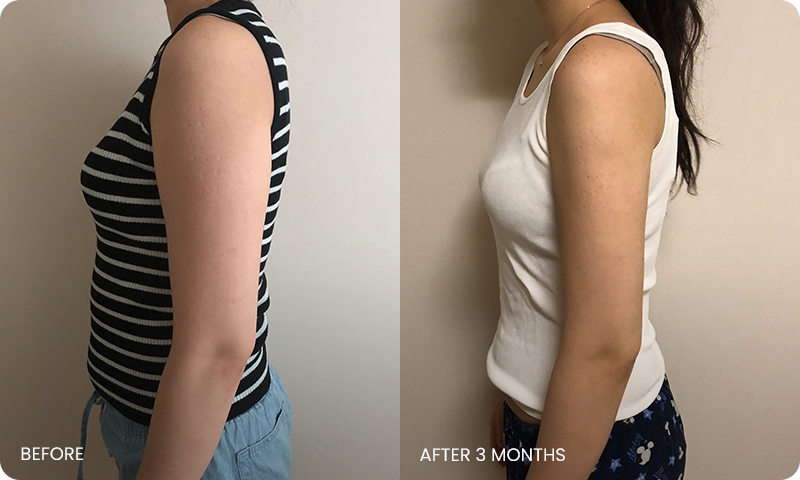 I-line arm liposuction bna