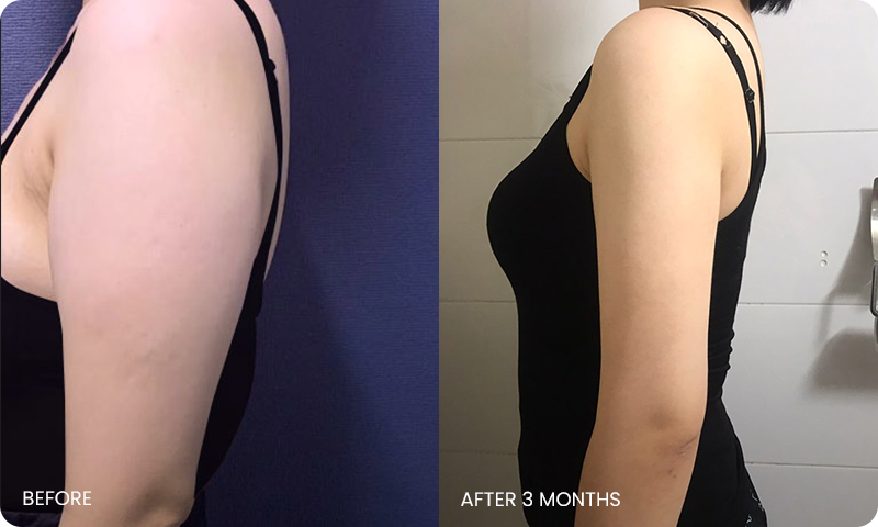 I-line arm liposuction bna