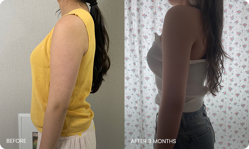 I-line arm liposuction bna