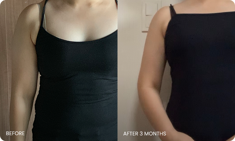 I-line arm liposuction bna
