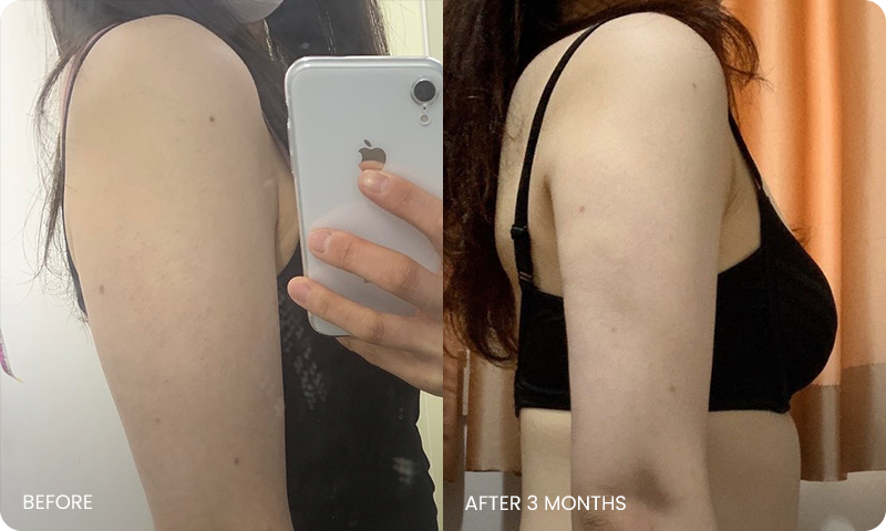 I-line arm liposuction bna