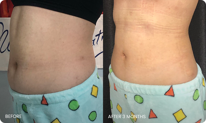abdominal liposuction bna