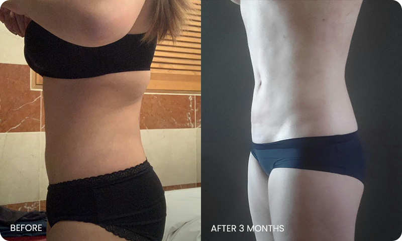 abdominal liposuction bna