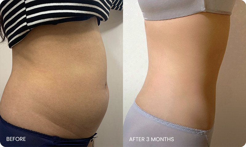 abdominal liposuction bna