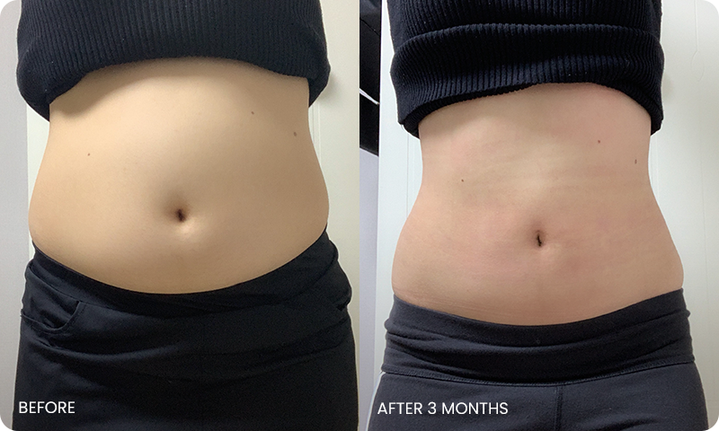 abdominal liposuction bna