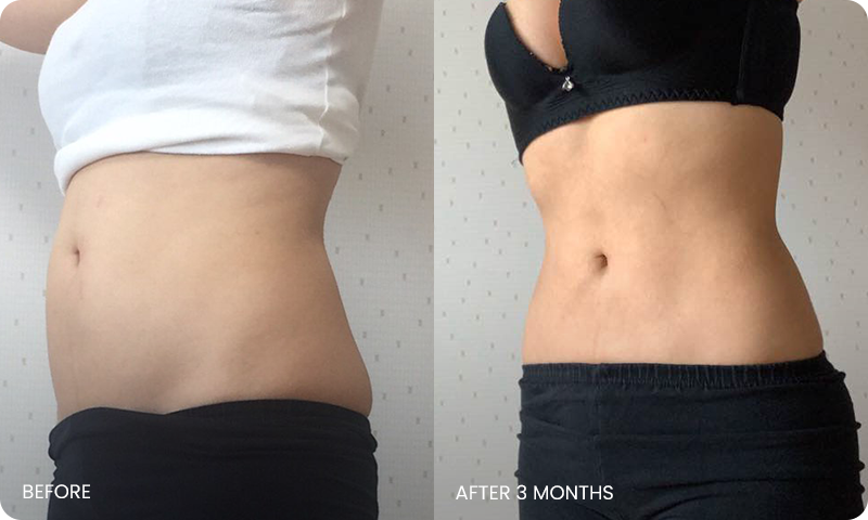 abdominal liposuction bna