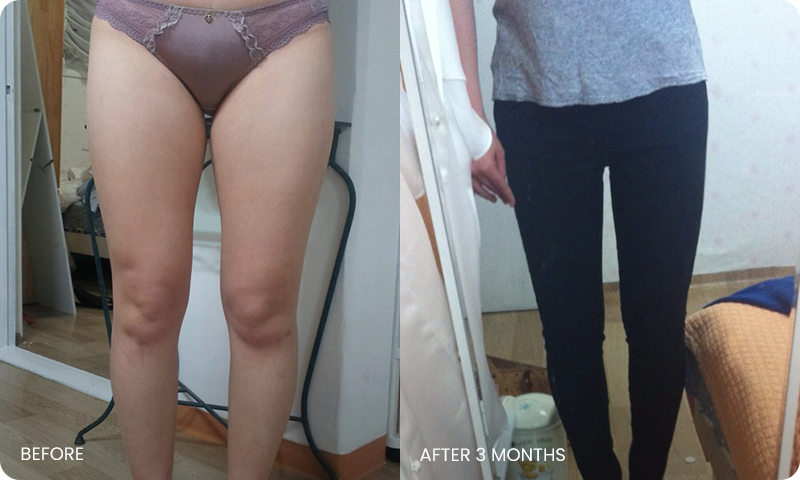 thigh 3D liposuction bna