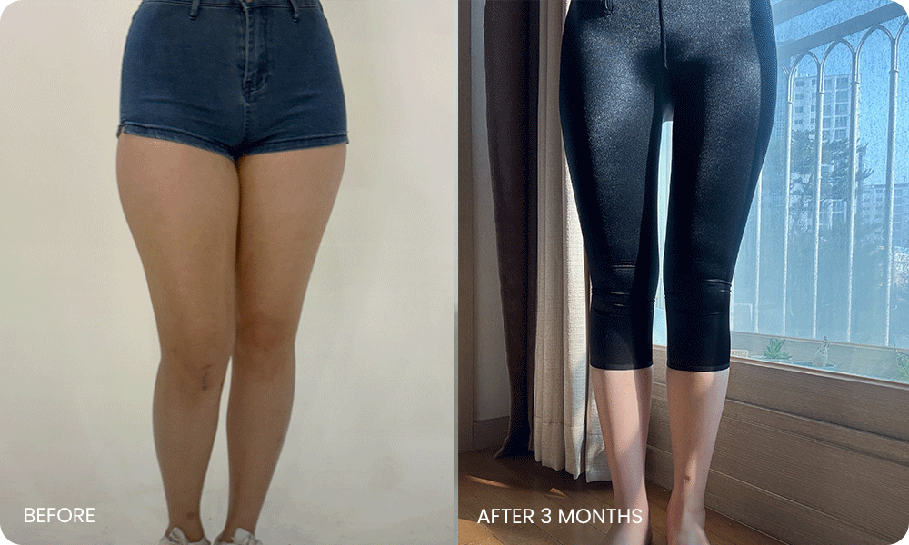 thigh 3D liposuction bna