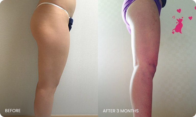 thigh 3D liposuction bna