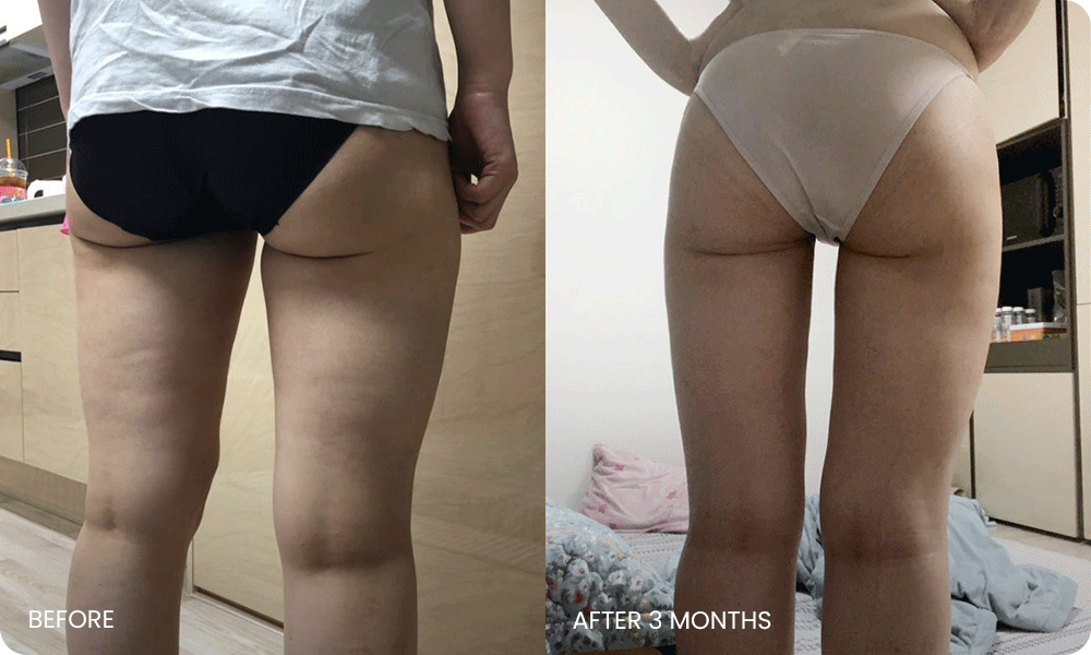 thigh 3D liposuction bna