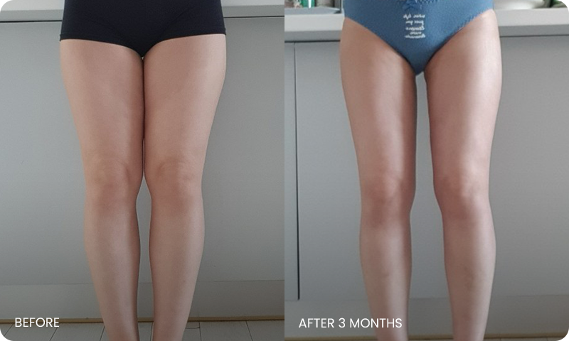 thigh 3D liposuction bna