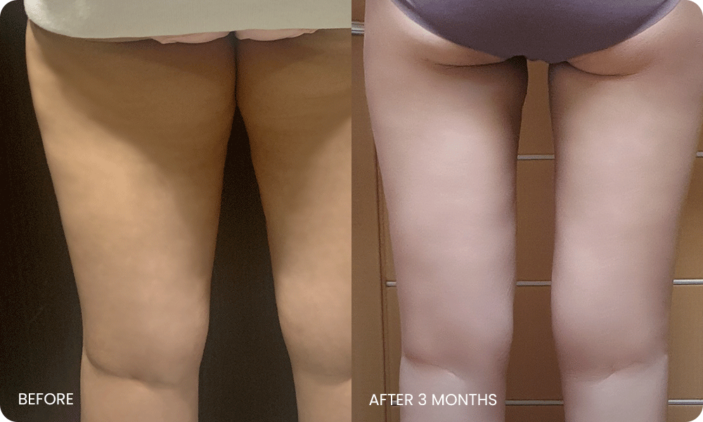 thigh 3D liposuction bna