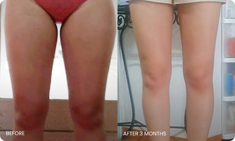 thigh 3D liposuction bna