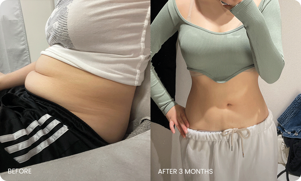 arm and abdominal liposuction liposuction bna