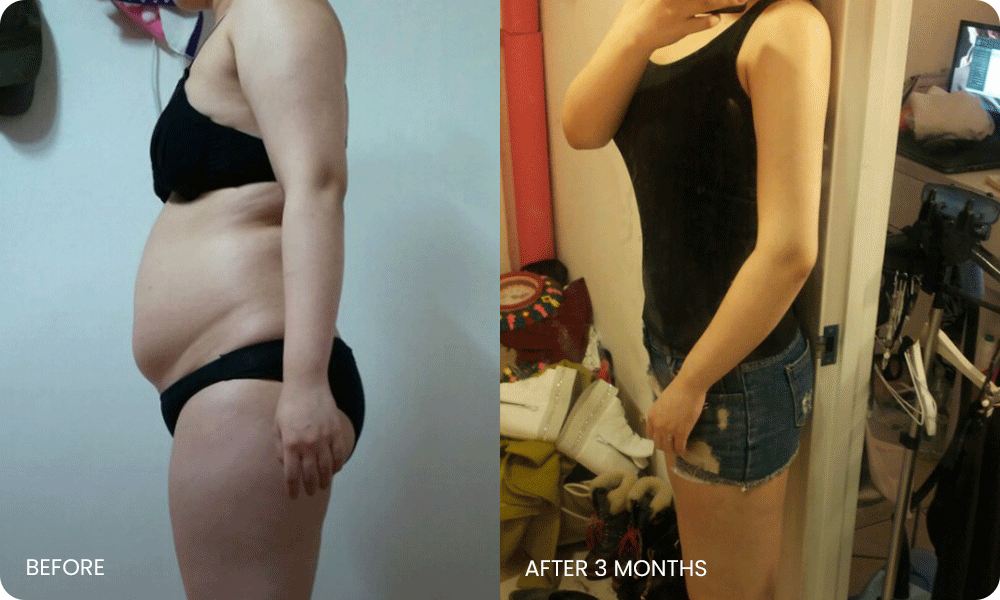 arm and abdominal liposuction liposuction bna