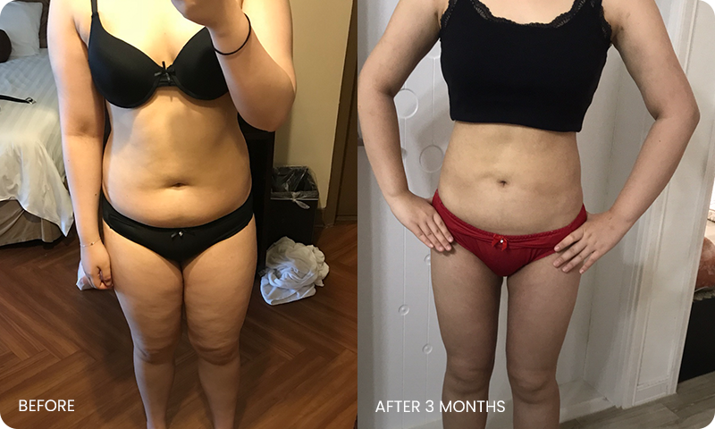 arm and abdominal liposuction liposuction bna