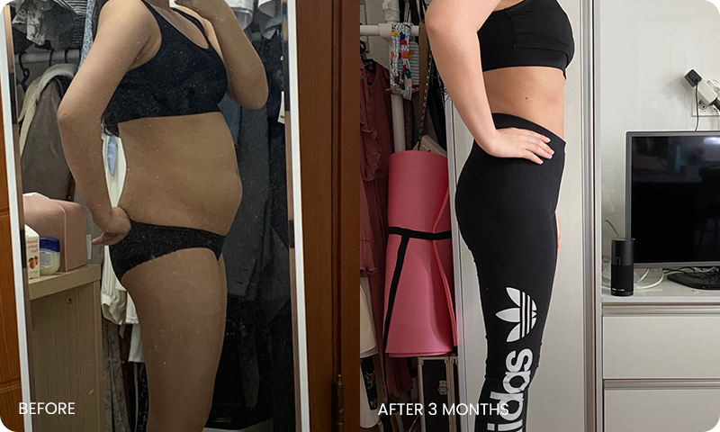 arm and abdominal liposuction liposuction bna