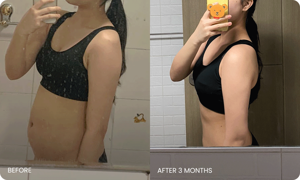 arm and abdominal liposuction liposuction bna