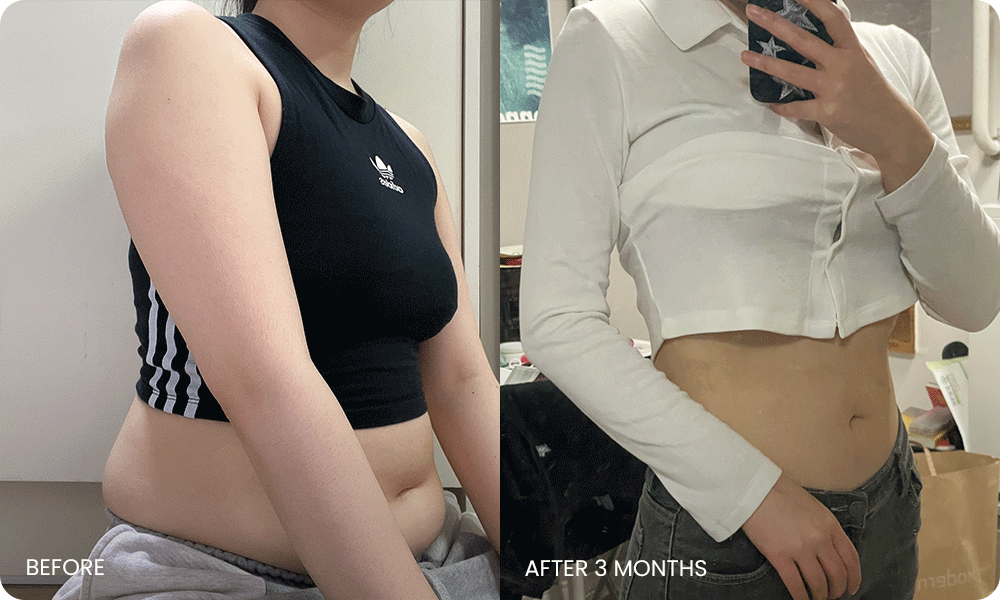 arm and abdominal liposuction liposuction bna