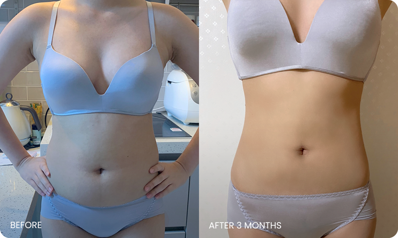 arm and abdominal liposuction liposuction bna