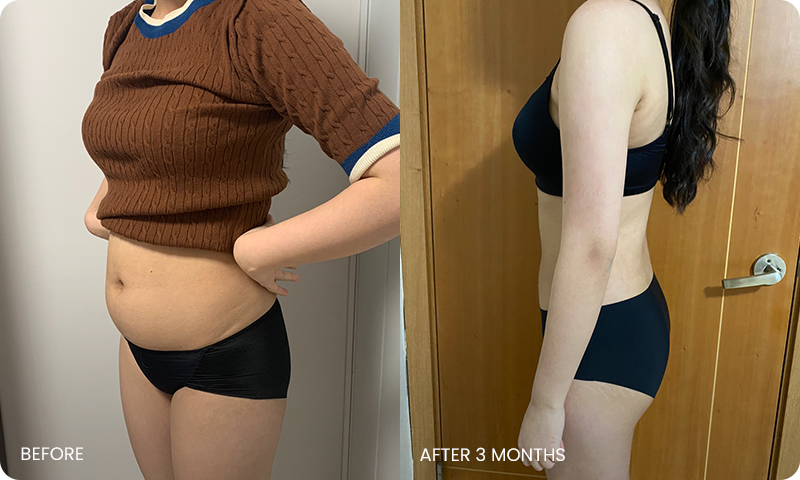 arm and abdominal liposuction liposuction bna