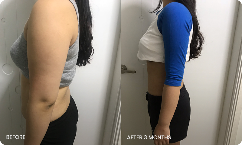 arm and abdominal liposuction liposuction bna
