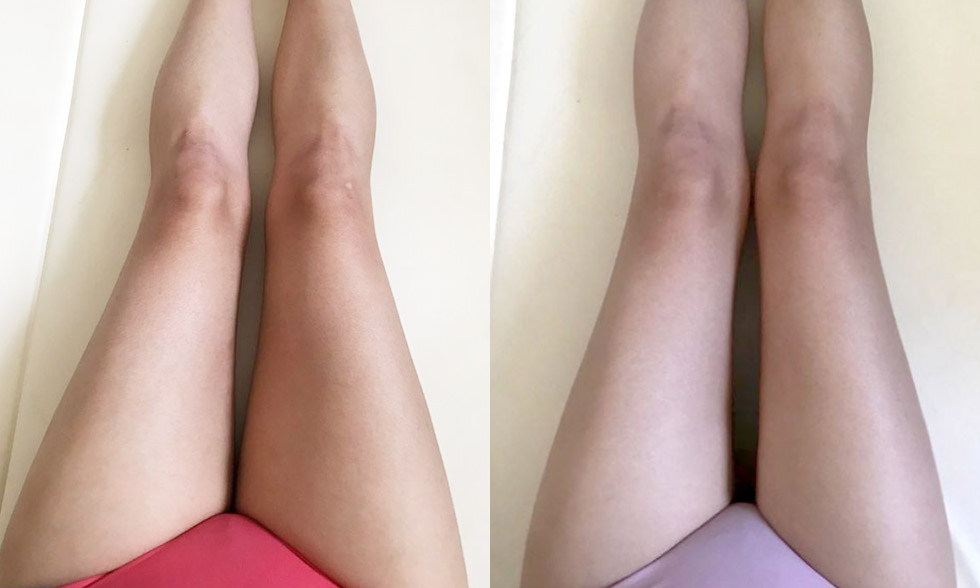 No. 2 treatment site Inner thighs전후사진