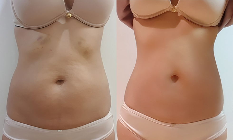 No. 3 treatment site Love handles, upper abdomen, lower abdomen 전후사진