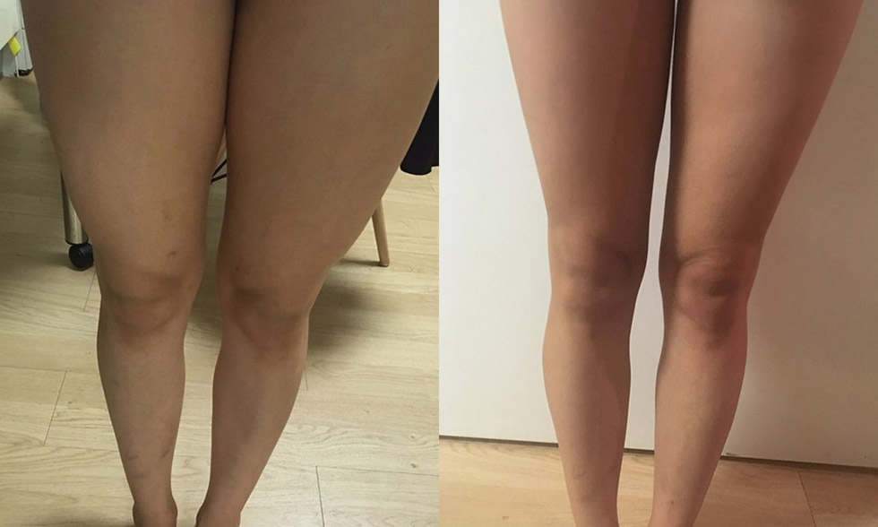 No. 4 treatment site Outer thighs 전후사진