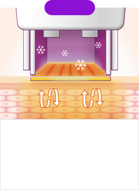 STEP 04 The cooling system continues operating while the RF energy and heat penetrates deep into the skin