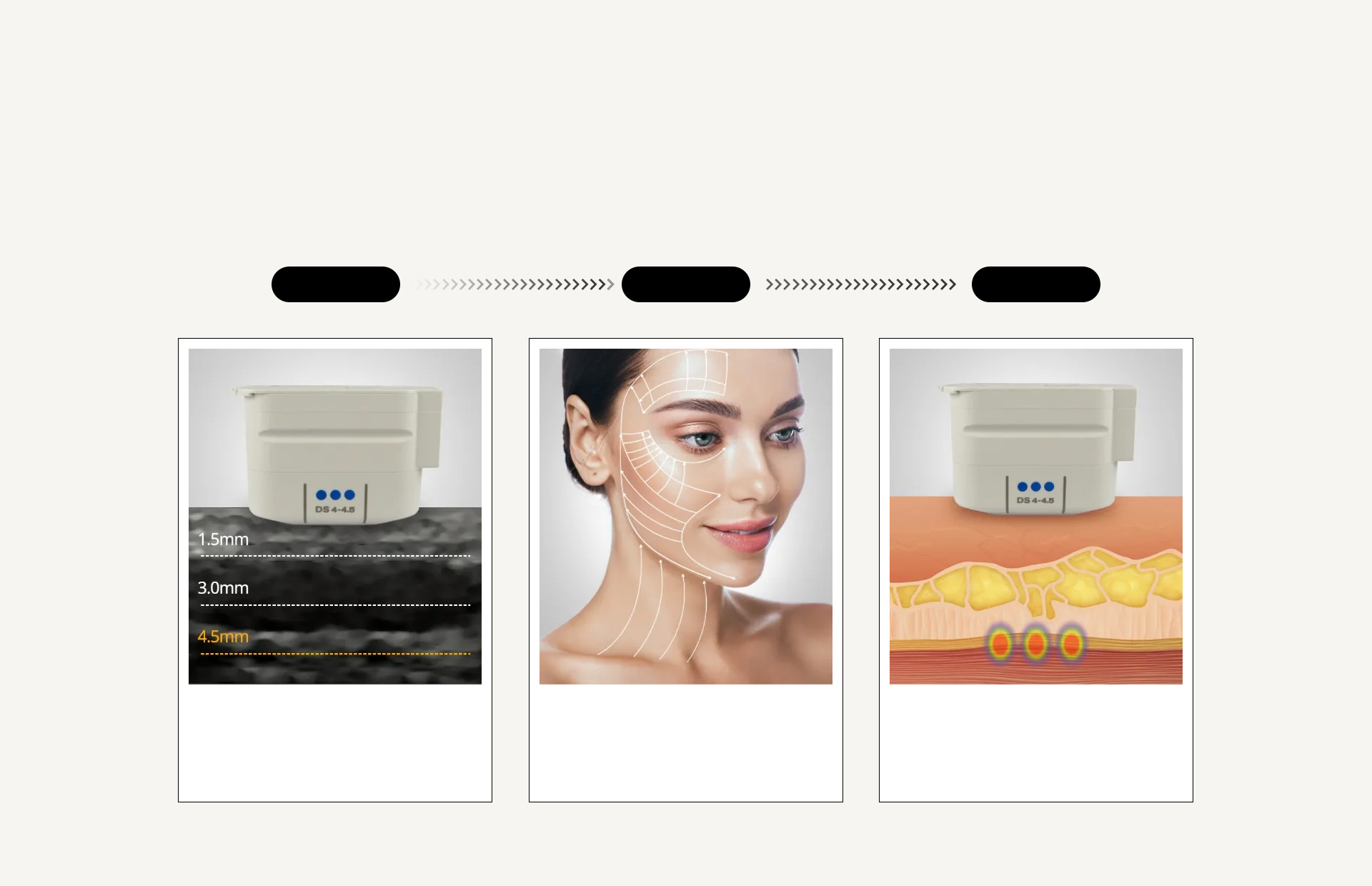 Visible Lifting Effect, Ultherapy Prime
