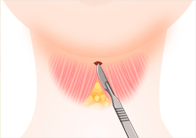 STEP 02 An incision is made in the platysma (neck muscle).