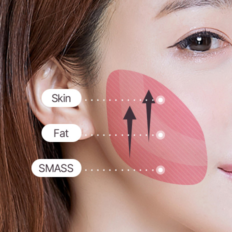 Loose skin is removed and to the SMAS is pulled up and fixed in place