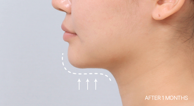 The double chin reduction procedure performed at Say Yes involves not just the removal of subcutaneous fat (double chin liposuction + double chin muscle tying), but the tying of the muscles. This helps restore the reduced skin elasticity and create a beautiful jawline, which could not be achieved with diet or surgery alone.