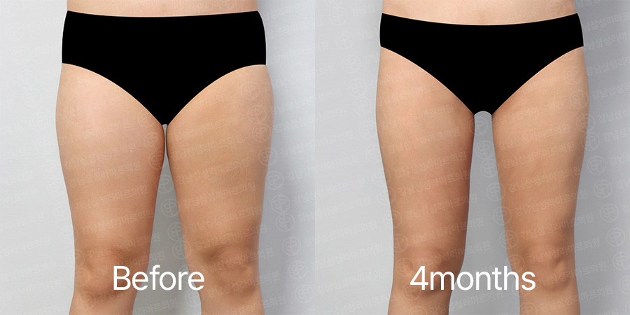 LookFat b&a photo
