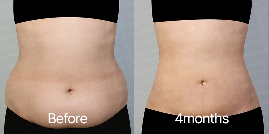 Abdominal360 b&a photo