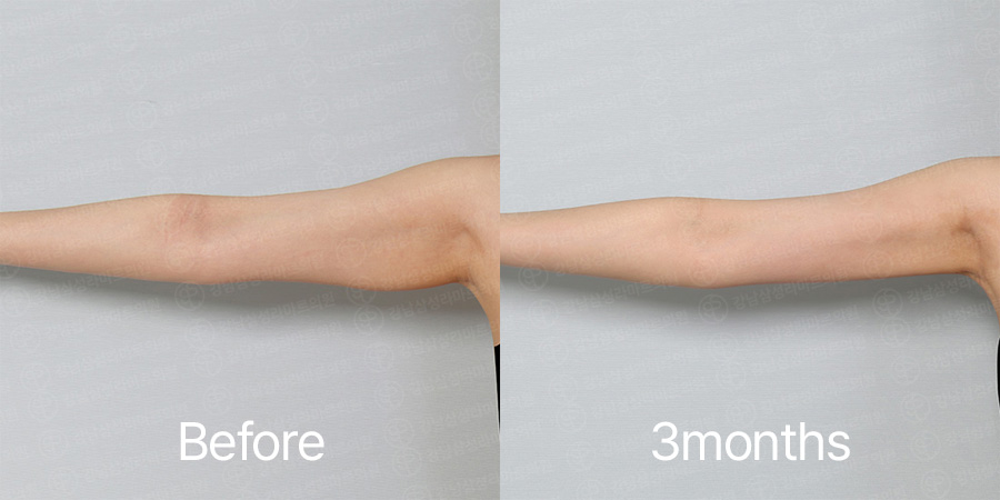 Arm360 b&a photo