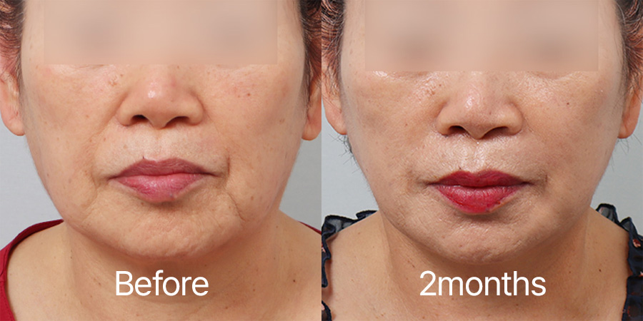 Facelift b&a photo
