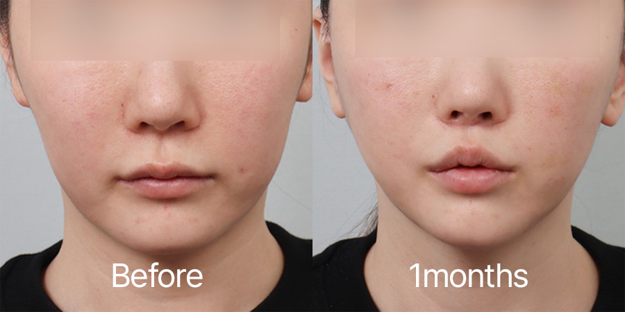 Facelift b&a photo