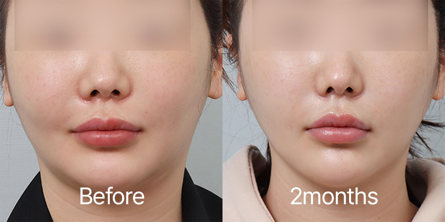 Facelift b&a photo
