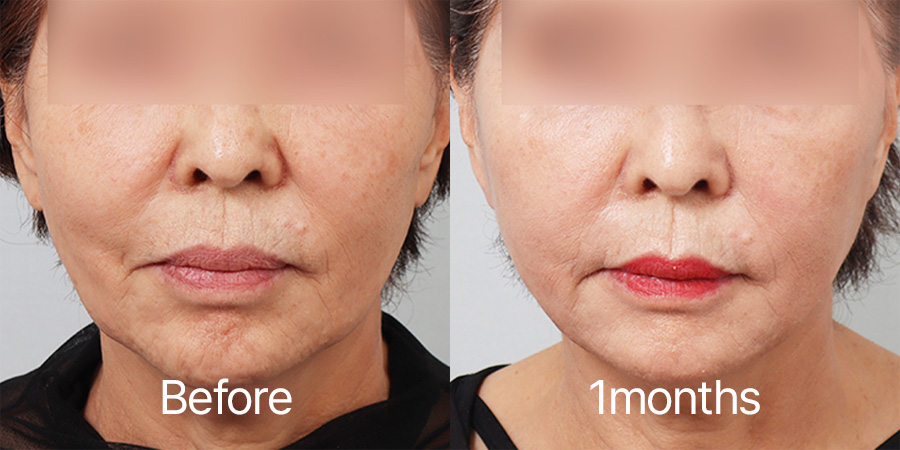 Facelift b&a photo