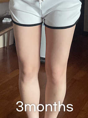Thigh Liposuction b&a photo