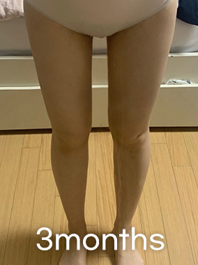Thigh Liposuction b&a photo