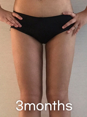Thigh Liposuction b&a photo