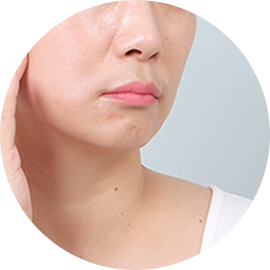 Conventional Mini Lifting 2 to 3cm incision Takes over 1 hour Improvement of the midface